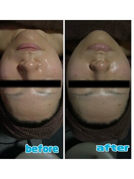 ラクラク(rakuraku)/リフトアップフェイシャル20代女