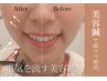 【8月限定】一番人気！電気を流す美容鍼40分　￥6600→￥4000