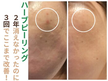 エリン(ERIN)/ハーブピーリング　３回目