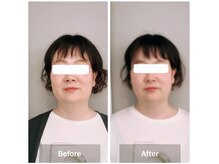 ラニ(Lani)/小顔美人整顔