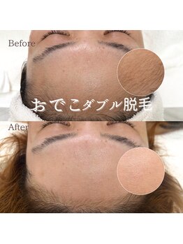 ナナイロサロン ニコリー(NaNairo nicolly)/【おでこワックス×光脱毛】