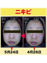 ベティ アンド ボーテ/ニキビ改善