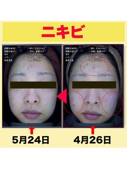 ベティ アンド ボーテ/ニキビ改善