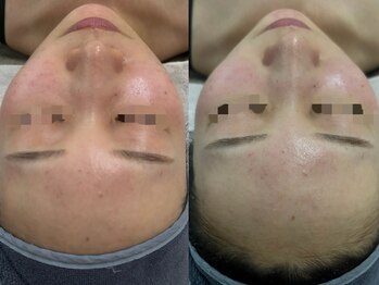 ファーファラ(Farfalla)/ハーブピーリング