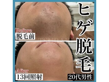 ツバキ(TSUBAKI)/ヒゲ脱毛