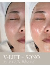エムネ ラボ 大阪本町(M/NE &nbsp;LAB)/V-LIFT＋SONO　リフティング