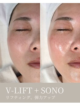 エムネ ラボ 大阪本町(M/NE LAB)/V-LIFT+SONO リフティング