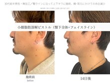 サボラミ(sabor A Mi)/顎下全体　脂肪分解ピストル 