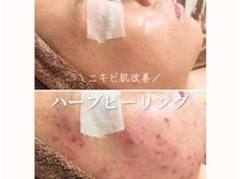 アナシアビューティーサロン(Anacia)の雰囲気（毛穴・ニキビケア【艶肌ハーブピーリング】）
