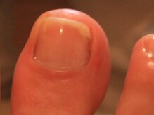 ピュアフット仙台駅前店/⇒早めのケアが大切です！