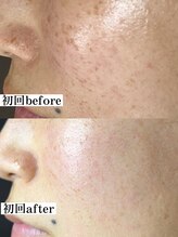 ティーツリー 名古屋 桜山(Tea Tree)/徹底したシミケアです