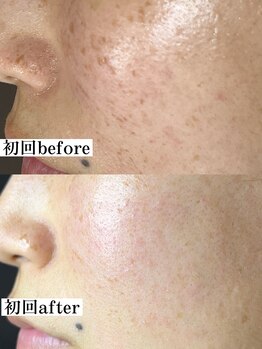 ティーツリー 名古屋 桜山(Tea Tree)/徹底したシミケアです