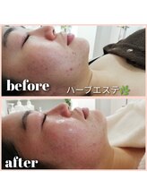 エクラ(eclat)/【ハーブエステ】ピカピカ艶々！