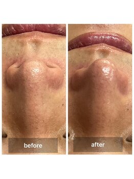 アットウィル 志木店(at will)/メンズ毛穴洗浄BeforeAfter