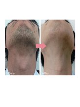 レア(Rea)/メンズひげ脱毛