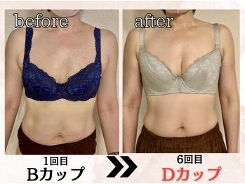 プリマ(prima)/バストアップ症例