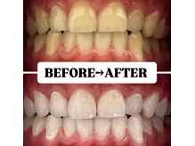 ホワイトニングサロン 豊中/Before&After美白ホワイトニング