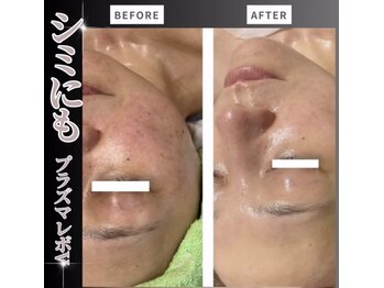 オリーブ(Olive)/肝斑、しみ、くすみの改善に