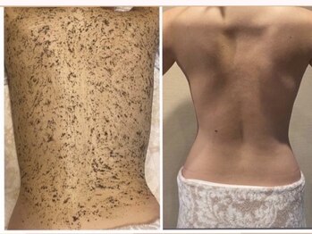 ビ ボーテ(美 Beaute)/背中ニキビケアにはハーブ一択!