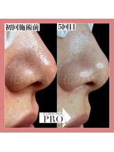 ハナノワ(花のWA)/毛穴図鑑