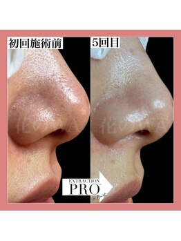 ハナノワ(花のWA)/毛穴図鑑