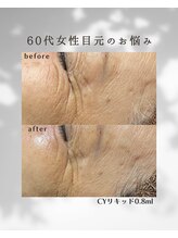 ヒーリングハーツ(Healing Hearts)/ハーブピーリング/シワ改善！