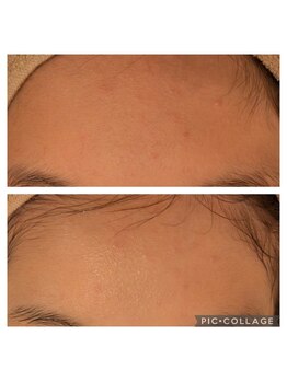 フェローズリンパケア(FELLOWS)/ピーリング+エポスキン