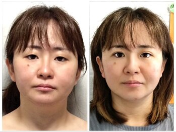 美容整体ウェリナ あま甚目寺院/.【小顔矯正before→after】