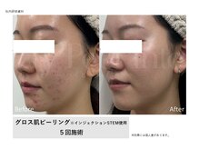 グロウラ(GrowRa)の雰囲気（グロス肌ピーリングエステを５回施術でニキビが改善されている）
