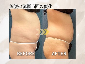 ビーホープ(B.hope)の写真/ぽっこりお腹を卒業！40代から始める理想のウエストづくり。何をしても痩せないお腹に、本気のサイズダウン