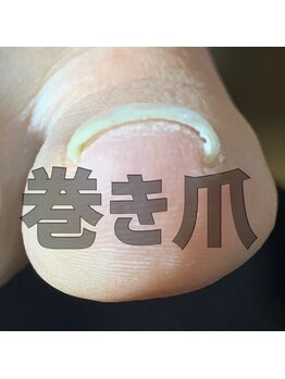 ユキネイル(YUKINAIL)/【トラブルネイル】巻いている爪