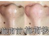 【強力毛穴集中コース】★毛穴洗浄80分★他店でご満足いただけなかった方も◎