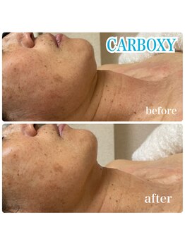 ルマエクレ(rmaecla)/たるみ改善