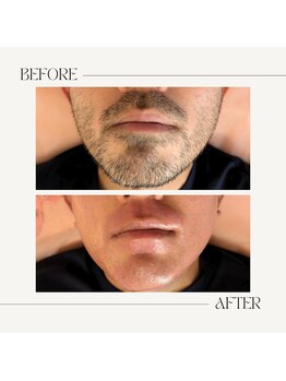 スプランドゥール(Splendeur)/メンズ【ひげ】WAX+光