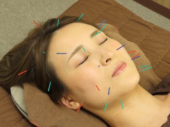 ナンバーテン整骨院(No.10整骨院)/美容鍼は3種類！