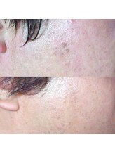 アモリアージュ(Amolliage)/しみ改善