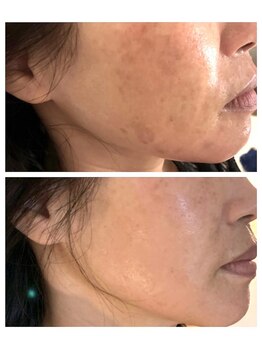 アルマサロン 菊陽(Almasalon)/【HAAB REPRO】ハーブリプロ