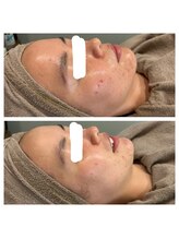 モンド 駒込店(monde)/ハーブピーリング