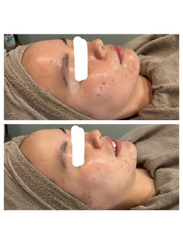 モンド 駒込店(monde)/ハーブピーリング