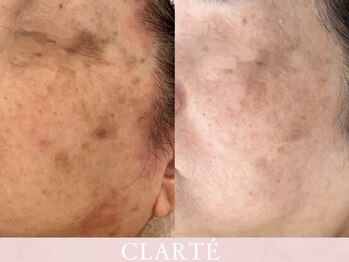 クラルテ(CLARTE)/ゆっくりアプローチしていきます