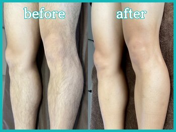 スキンマネジメント 横浜/【Before & After】脚全体
