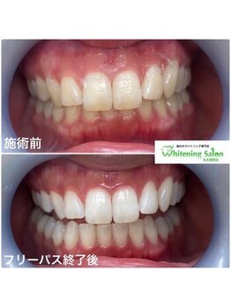 ホワイトニングサロン 名古屋駅店/【ホワイトニング施術例】
