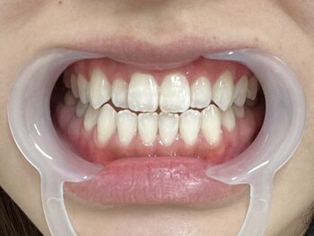 プラネット 池袋東口店の写真/【選べるホワイトニングであなたの理想の白さを!】月額通い放題プランで、コスパも効果も抜群です◎