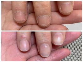 深爪矯正でコンプレックス解消！