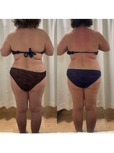 エン ボディアンドフェイシャル(En)/NEW☆ハイパーナイフ痩身上半身