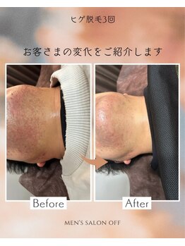 オフ(off)/ヒゲ脱毛