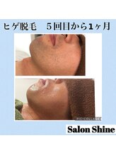 サロンシャイン(Salon Shine)/◆メンズヒゲ脱毛の経過◆