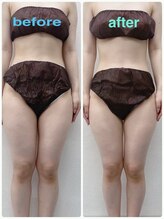 ハロ 南青山(HALO)/全身キャビラジ+太もも脂肪取り