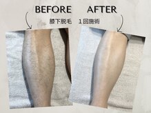 ワンアップ(One-up)/膝下脱毛 １回　before  after