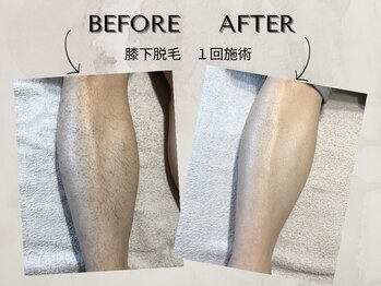 ワンアップ(One-up)/膝下脱毛 １回　before  after